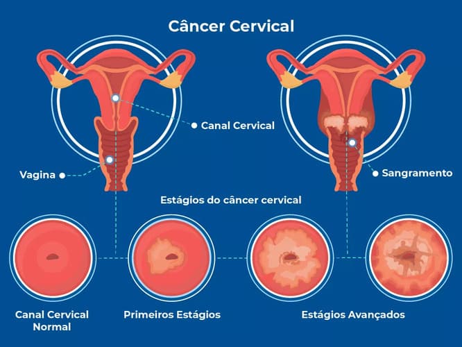 O infográfico mostra os estágios do câncer de colo de útero ou câncer cervical. A imagem mostra o canal cervical normal, e com a doença em diferentes estágios. A condição pode causar dor e sangramento vaginal. O infográfico mostra os estágios do câncer de colo de útero ou câncer cervical. A imagem mostra o canal cervical normal, e com a doença em diferentes estágios. A condição pode causar dor e sangramento vaginal.