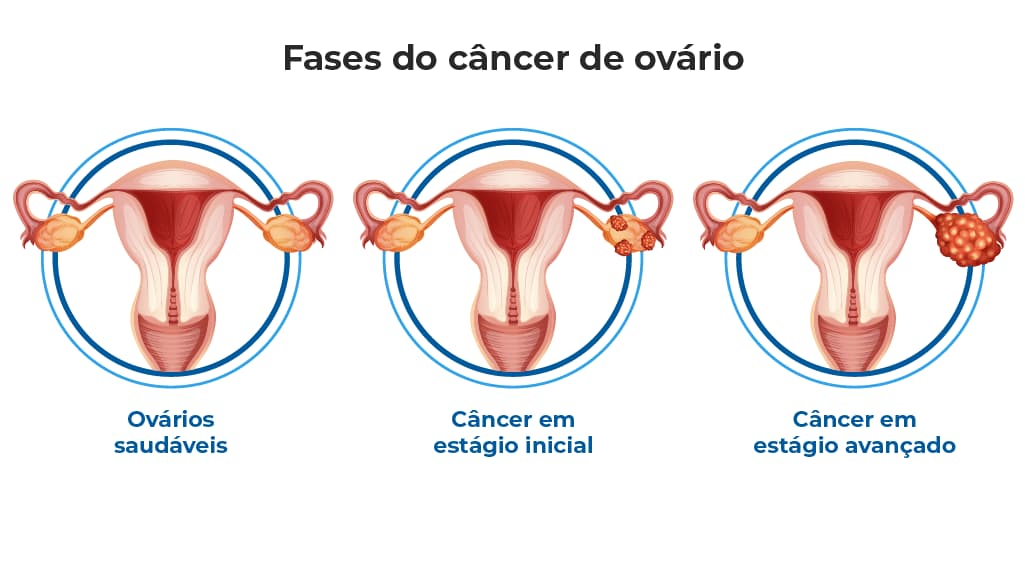 Ilustração das fases do câncer de ovário que mostra três estágios: ovários saudáveis, câncer em estágio inicial com pequeno crescimento tumoral em um dos ovários, e câncer em estágio avançado com crescimento tumoral significativo. Ilustração das fases do câncer de ovário que mostra três estágios: ovários saudáveis, câncer em estágio inicial com pequeno crescimento tumoral em um dos ovários, e câncer em estágio avançado com crescimento tumoral significativo.