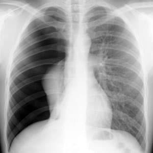 Radiografia do tórax para diagnosticar pneumotórax. Radiografia do tórax para diagnosticar pneumotórax.