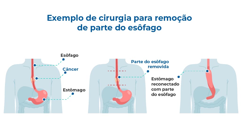 A ilustração compara três imagens do esôfago. A primeira mostra o esôfago com câncer, a segunda destaca a parte que será removida devido à doença, e a terceira apresenta o esôfago conectado ao estômago após a remoção da área afetada A ilustração compara três imagens do esôfago. A primeira mostra o esôfago com câncer, a segunda destaca a parte que será removida devido à doença, e a terceira apresenta o esôfago conectado ao estômago após a remoção da área afetada