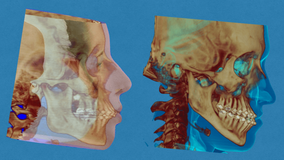 A imagem ilustra reconstruções tridimensionais de perfis craniofaciais em cortes laterais, destaca alterações ósseas e de tecidos moles, como projeção ou retração da mandíbula e maxila. A imagem ilustra reconstruções tridimensionais de perfis craniofaciais em cortes laterais, destaca alterações ósseas e de tecidos moles, como projeção ou retração da mandíbula e maxila.