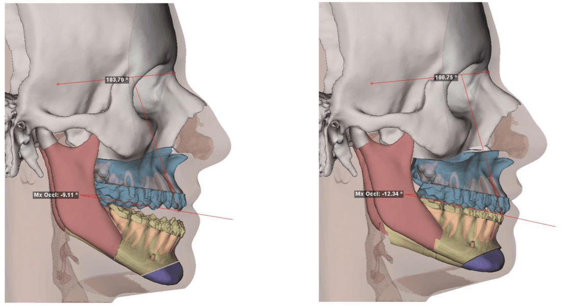 A imagem exibe cortes laterais do crânio com ângulos e medidas relacionados à posição mandibular e maxilar A imagem exibe cortes laterais do crânio com ângulos e medidas relacionados à posição mandibular e maxilar