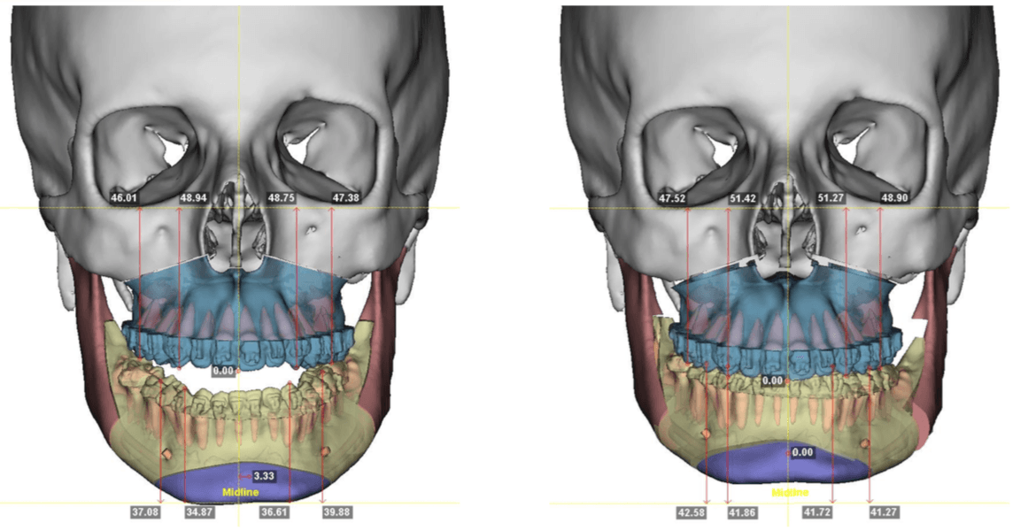 A imagem mostra uma visão frontal do crânio com medições detalhadas das estruturas ósseas. A imagem mostra uma visão frontal do crânio com medições detalhadas das estruturas ósseas.