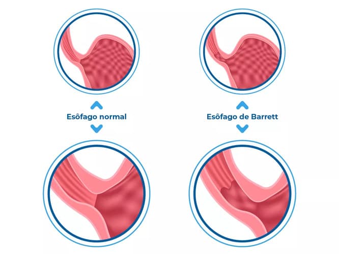 A ilustração mostra uma comparação entre um esôfago normal e um esôfago de Barrett. A imagem contém quatro círculos com imagens de esôfago. À esquerda, os círculos mostras a aparência do esôfago normal. À direita, os círculos mostram o esôfago de Barrett, e apresentam anatomias que indicam a alteração celular típica dessa condição A ilustração mostra uma comparação entre um esôfago normal e um esôfago de Barrett. A imagem contém quatro círculos com imagens de esôfago. À esquerda, os círculos mostras a aparência do esôfago normal. À direita, os círculos mostram o esôfago de Barrett, e apresentam anatomias que indicam a alteração celular típica dessa condição
