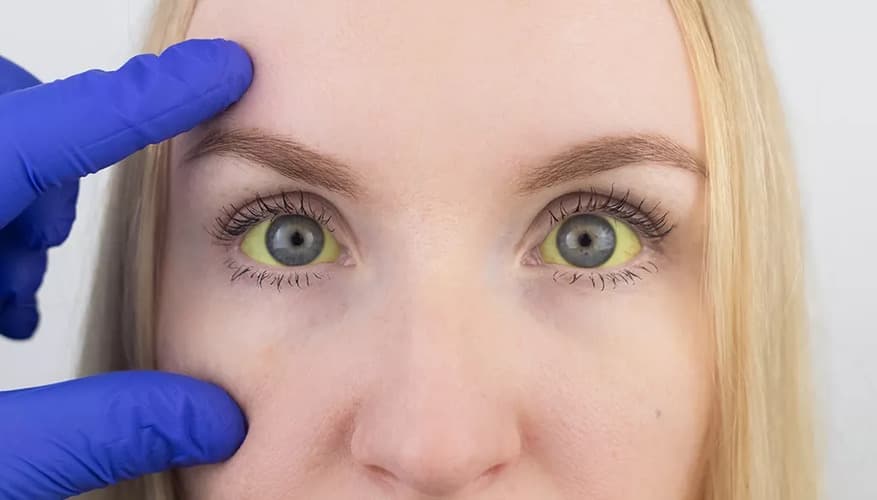 A imagem mostra mão com luva azul que examina a área ao redor dos olhos de uma mulher com icterícia, um dos sintomas da hepatite viral. A imagem mostra mão com luva azul que examina a área ao redor dos olhos de uma mulher com icterícia, um dos sintomas da hepatite viral.