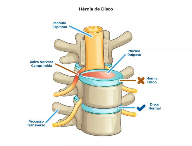 Vista lateral de ilustração 3D que mostra parte de uma coluna vertebral e compara hérnia de disco com e sem lesão Vista lateral de ilustração 3D que mostra parte de uma coluna vertebral e compara hérnia de disco com e sem lesão