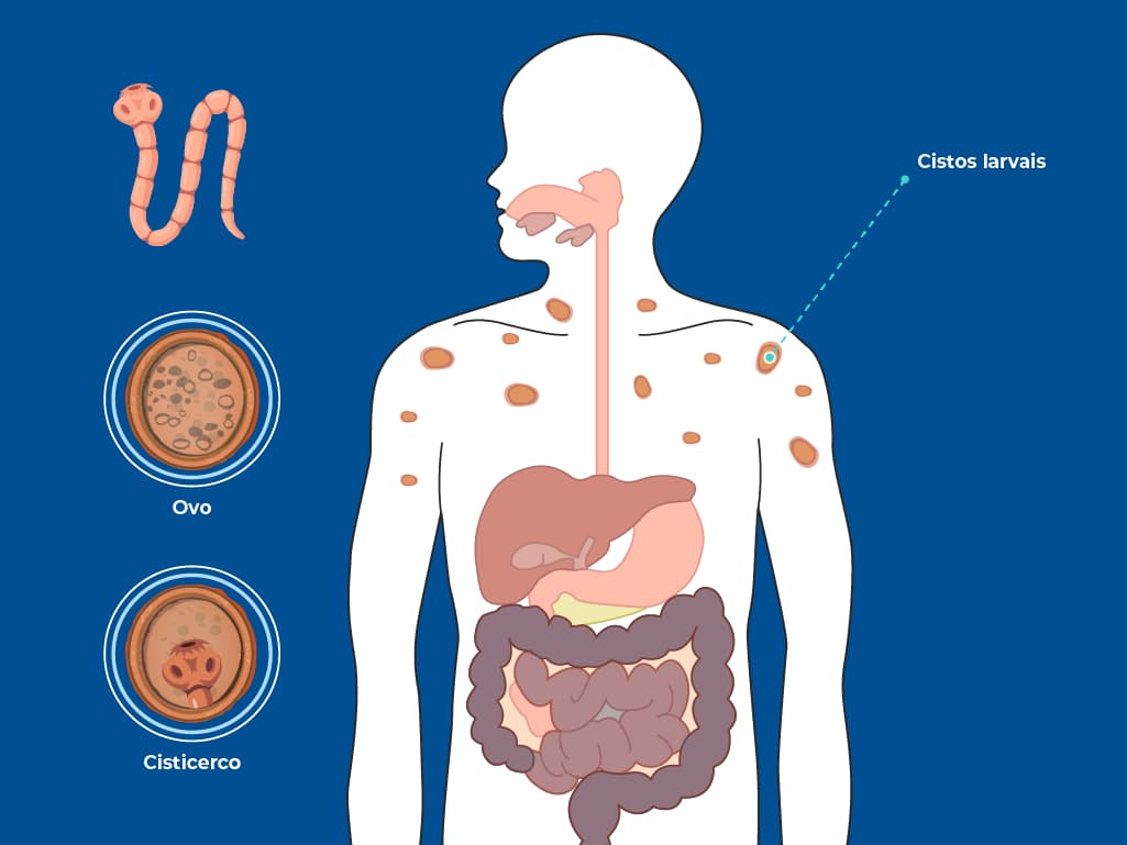 A imagem mostra o ciclo da Taenia Solium, evidenciando o ovo da tênia, a forma larval (cisticerco) e a localização de cistos larvais no corpo humano. A infecção pode causar cisticercose, com os cistos se espalhando por vários órgãos. A imagem mostra o ciclo da Taenia Solium, evidenciando o ovo da tênia, a forma larval (cisticerco) e a localização de cistos larvais no corpo humano. A infecção pode causar cisticercose, com os cistos se espalhando por vários órgãos.