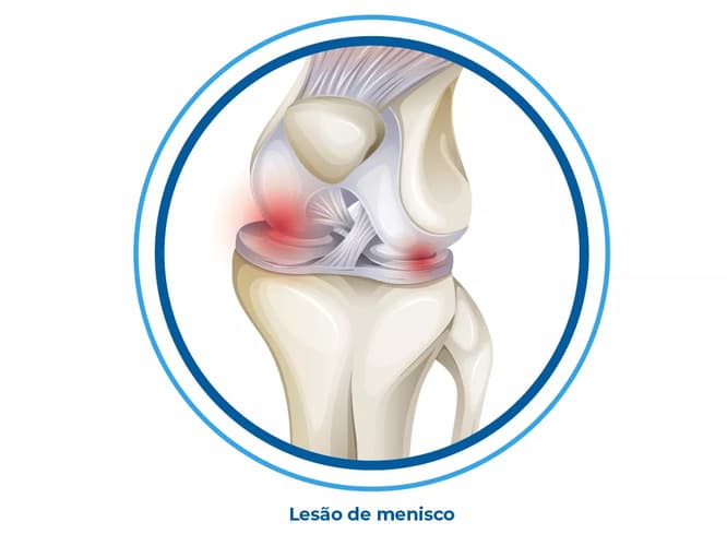 Imagem de lesão no menisco do joelho Imagem de lesão no menisco do joelho