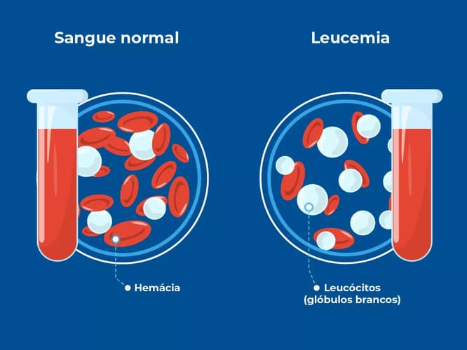 Comparação entre sangue normal e com leucemia. À esquerda, um tubo de ensaio com sangue que apresenta quantidade normal de hemácias ou glóbulos vermelhos, e leucócitos que são os glóbulos brancos. À direita, um tubo de ensaio com sangue de paciente com leucemia, com aumento significativo de leucócitos Comparação entre sangue normal e com leucemia. À esquerda, um tubo de ensaio com sangue que apresenta quantidade normal de hemácias ou glóbulos vermelhos, e leucócitos que são os glóbulos brancos. À direita, um tubo de ensaio com sangue de paciente com leucemia, com aumento significativo de leucócitos
