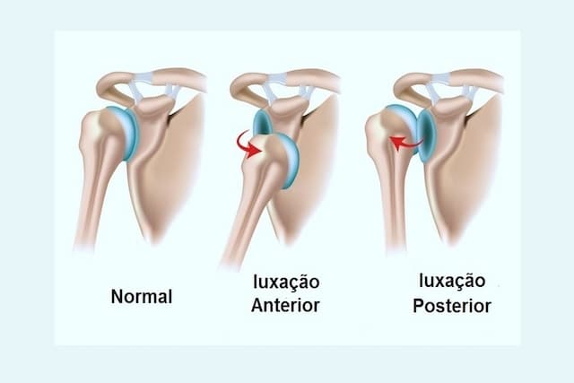 A imagem é um diagrama anatômico que apresenta três situações diferentes do ombro: Posição Normal; Luxação Anterior; Luxação Posterior A imagem é um diagrama anatômico que apresenta três situações diferentes do ombro: Posição Normal; Luxação Anterior; Luxação Posterior