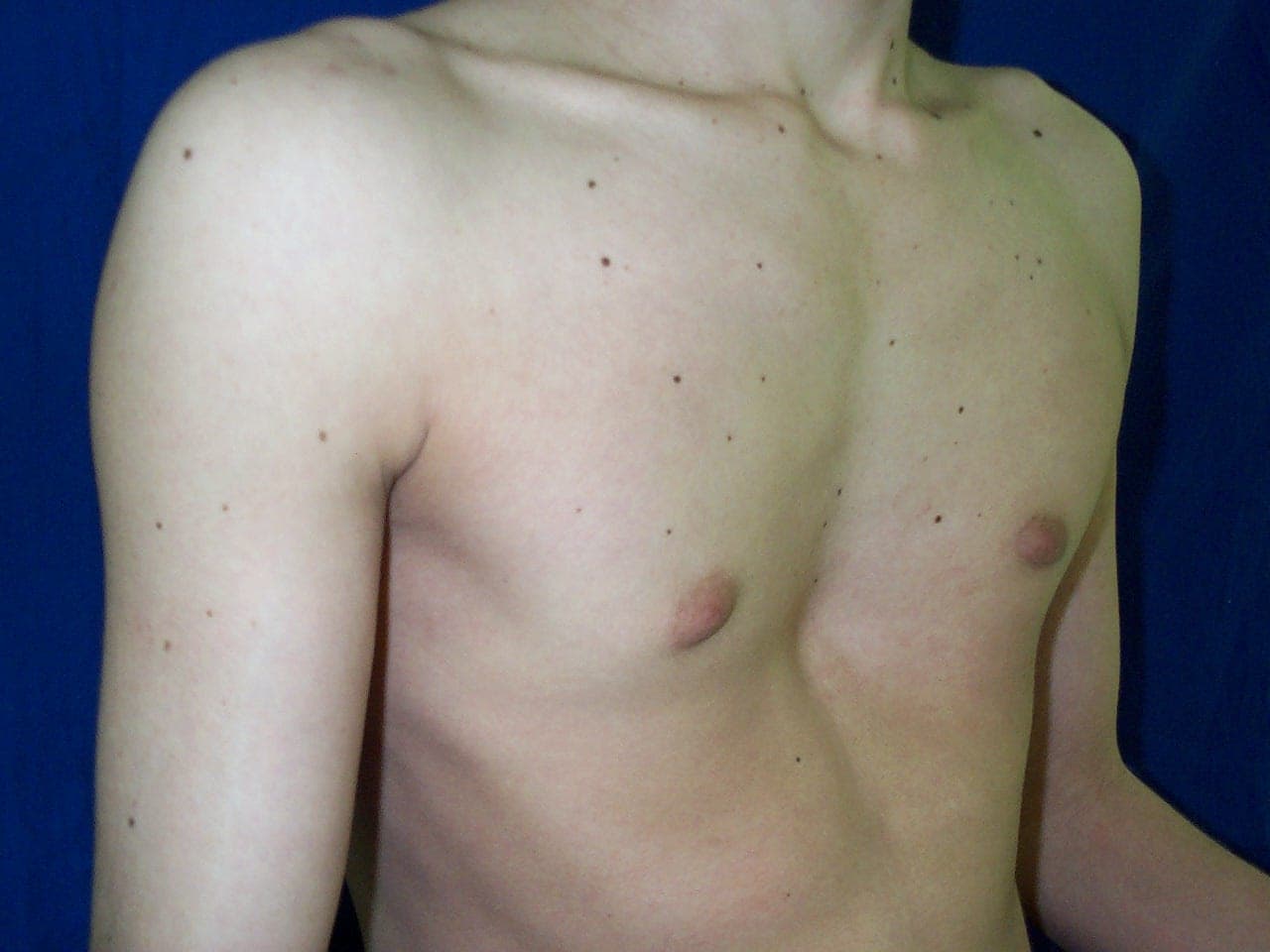 Foto frontal de uma pessoa com diagnóstico de Pectus Excavatum, que é uma deformidade da parede torácica conhecida pelos leigos como tórax em funil ou "peito de sapateiro". Foto frontal de uma pessoa com diagnóstico de Pectus Excavatum, que é uma deformidade da parede torácica conhecida pelos leigos como tórax em funil ou "peito de sapateiro".