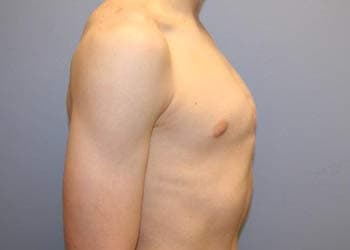 Foto de perfil de uma pessoa com diagnóstico de Pectus Carinatum, que é definido como a protrusão anterior do esterno, sendo uma enfermidade menos comum do que o Pectus Excavatum. Foto de perfil de uma pessoa com diagnóstico de Pectus Carinatum, que é definido como a protrusão anterior do esterno, sendo uma enfermidade menos comum do que o Pectus Excavatum.