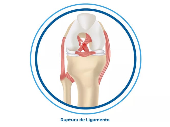 A ilustração mostra ossos do corpo humano e seus ligamentos. A imagem detalha o rompimento de um dos ligamentos, uma lesão comum dos praticantes de esporte A ilustração mostra ossos do corpo humano e seus ligamentos. A imagem detalha o rompimento de um dos ligamentos, uma lesão comum dos praticantes de esporte