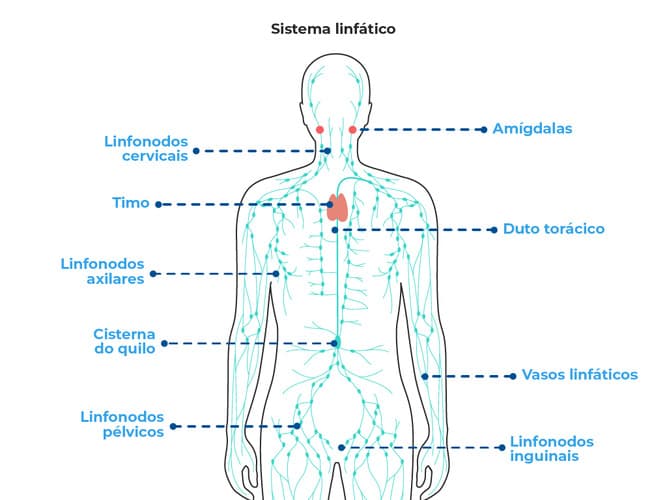A imagem mostra o sistema linfático humano, destacando os linfonodos cervicais, axilares, inguinais, pélvicos, além das amígdalas e do timo. Os gânglios linfáticos inchados estão em destaque, relacionando-se ao linfoma não- Hodgkin A imagem mostra o sistema linfático humano, destacando os linfonodos cervicais, axilares, inguinais, pélvicos, além das amígdalas e do timo. Os gânglios linfáticos inchados estão em destaque, relacionando-se ao linfoma não- Hodgkin
