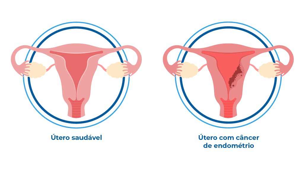 A imagem compara um útero saudável com um afetado por câncer de endométrio, destacando sintomas como dor abdominal e corrimento vaginal. A ilustração permite exemplificar a doença, a qual é um tumor maligno iniciado no revestimento interno do útero A imagem compara um útero saudável com um afetado por câncer de endométrio, destacando sintomas como dor abdominal e corrimento vaginal. A ilustração permite exemplificar a doença, a qual é um tumor maligno iniciado no revestimento interno do útero