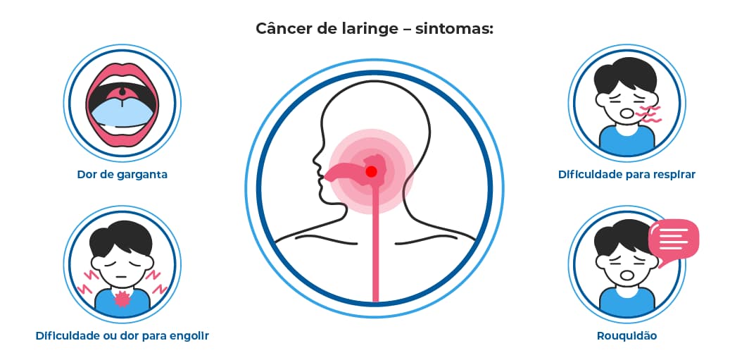 Ilustração mostra sintomas do câncer de laringe, como dor de garganta, dificuldade para respirar e engolir, rouquidão e voz rouca. Localização do tumor na garganta está destacada. Ilustração mostra sintomas do câncer de laringe, como dor de garganta, dificuldade para respirar e engolir, rouquidão e voz rouca. Localização do tumor na garganta está destacada.