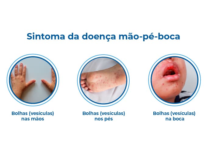 Três imagens que mostram crianças com bolhas nas mãos, nos pés e na boca, ilustrando um dos principais sintomas da doença mão pé boca. Três imagens que mostram crianças com bolhas nas mãos, nos pés e na boca, ilustrando um dos principais sintomas da doença mão pé boca.