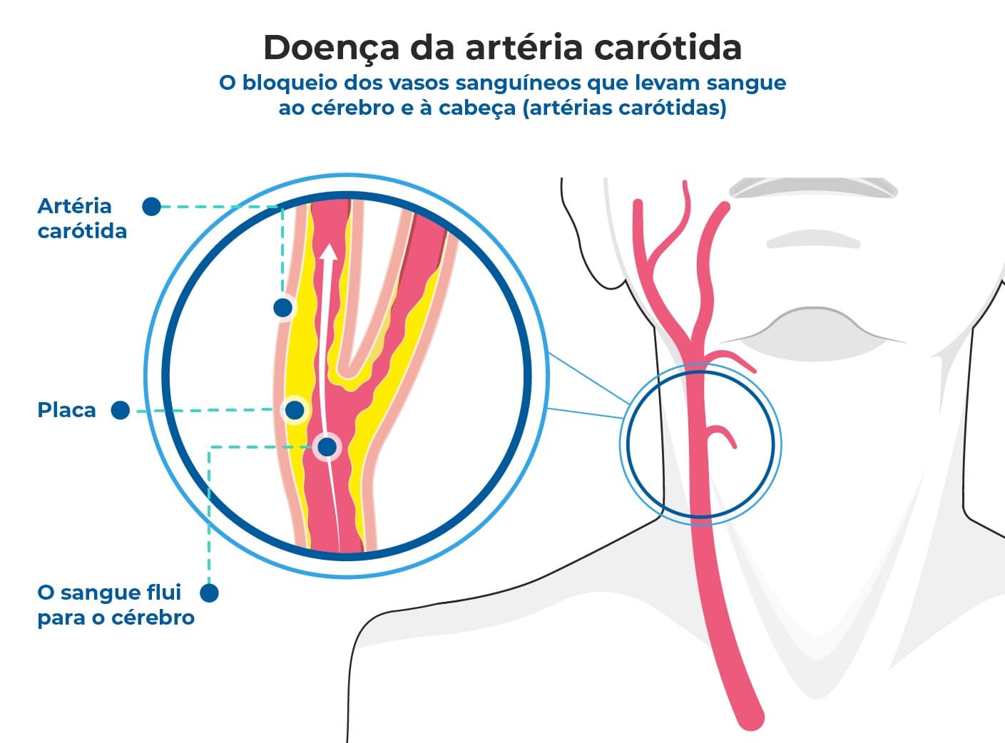 Ilustração mostra artérias carótidas afetadas pela doença aterosclerótica carotídea com placas formadas nas artérias. Fatores de risco como obesidade, sedentarismo, fumo, hipertensão, diabetes e possível necessidade de angioplastia com stent Ilustração mostra artérias carótidas afetadas pela doença aterosclerótica carotídea com placas formadas nas artérias. Fatores de risco como obesidade, sedentarismo, fumo, hipertensão, diabetes e possível necessidade de angioplastia com stent