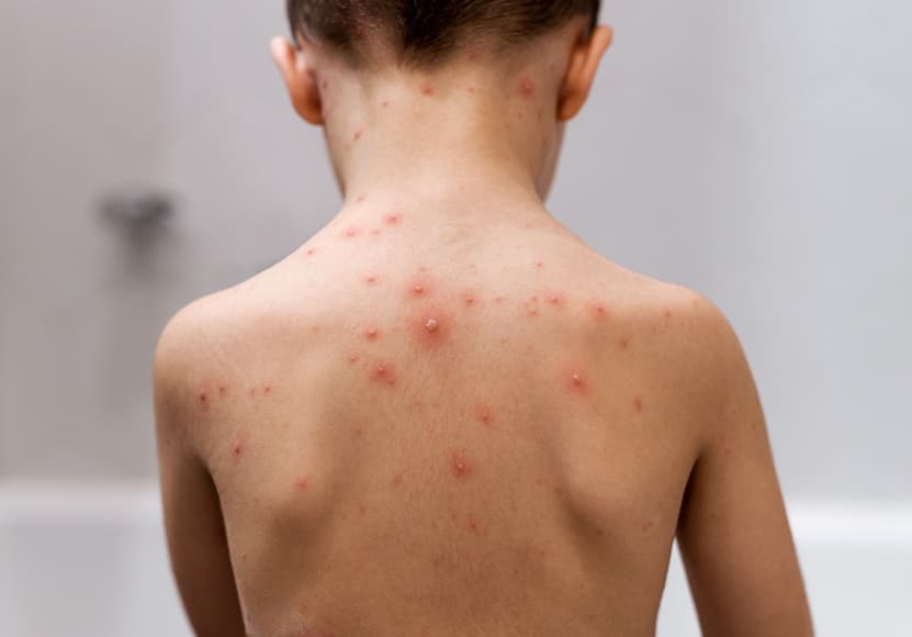Imagem de uma criança com erupções cutâneas nas costas e nuca, causadas por catapora (varicela). As manchas e bolhas vermelhas, sintomas de varicela, podem também estar em outras áreas do corpo. Imagem de uma criança com erupções cutâneas nas costas e nuca, causadas por catapora (varicela). As manchas e bolhas vermelhas, sintomas de varicela, podem também estar em outras áreas do corpo.