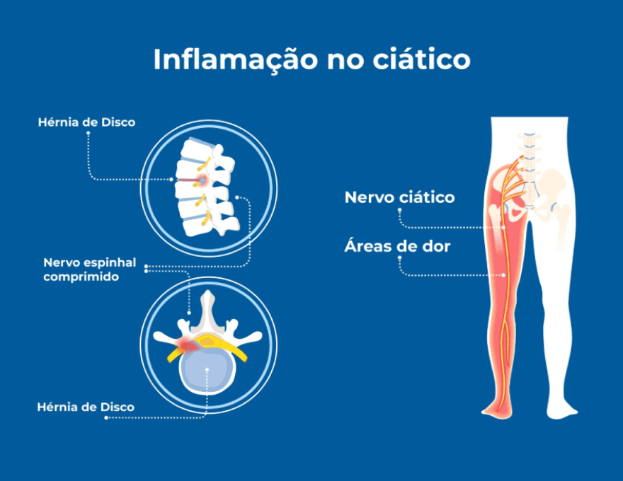 Imagem ilustrativa do nervo ciático comprimido, o que causa inflamação no nervo ciático e dor na perna. O infográfico apoia a explicação das causas, sintomas e como tratar a inflamação no nervo ciático. Imagem ilustrativa do nervo ciático comprimido, o que causa inflamação no nervo ciático e dor na perna. O infográfico apoia a explicação das causas, sintomas e como tratar a inflamação no nervo ciático.
