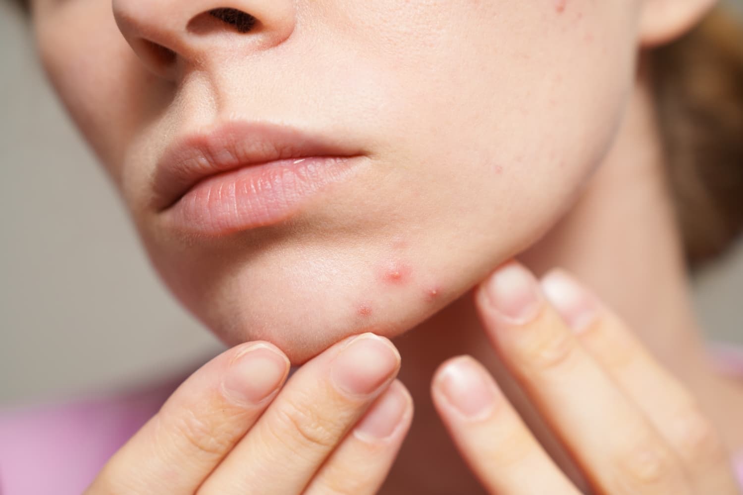 Uma pessoa com marcas de acne no rosto, principalmente na região do queixo.