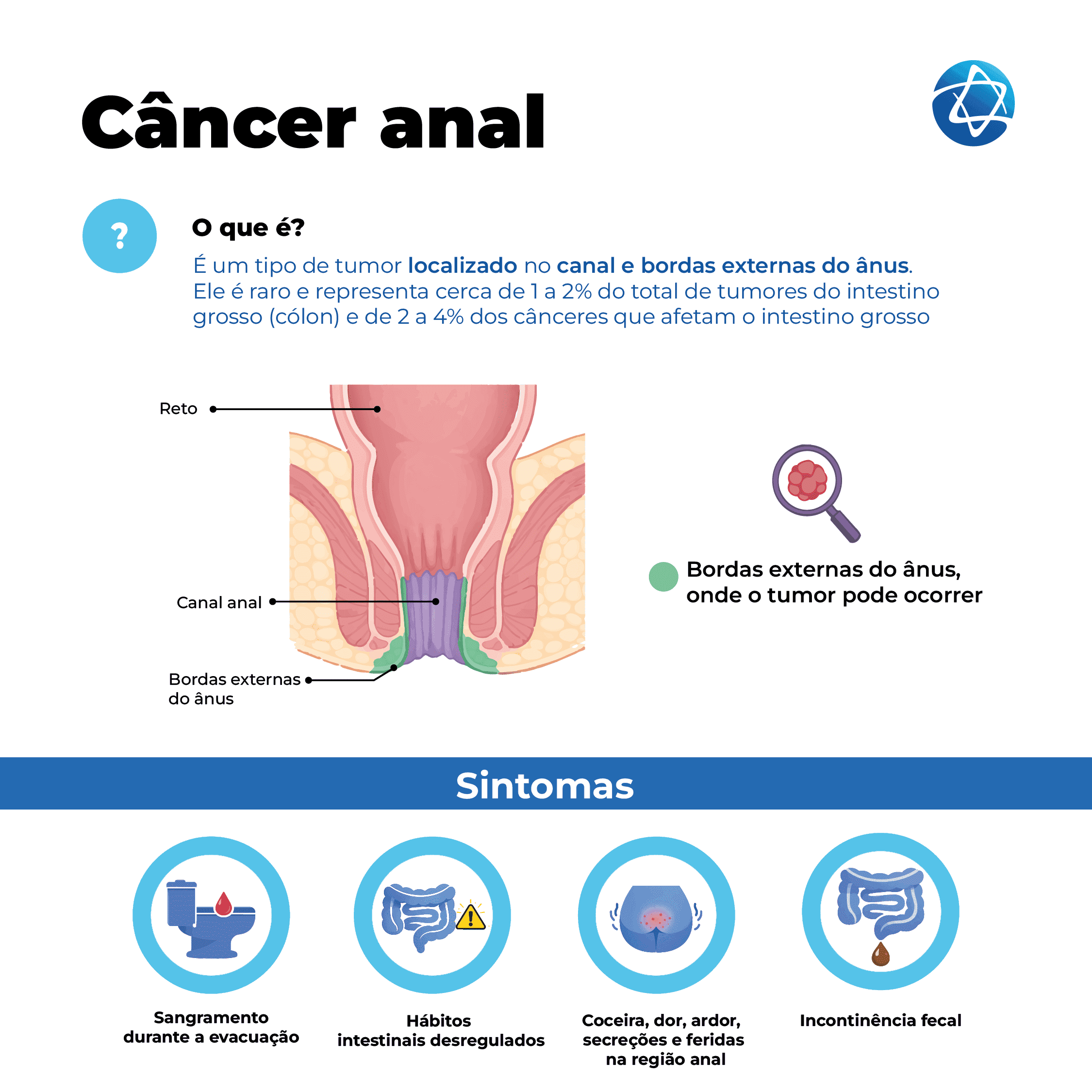 Infográfico sobre câncer anal com explicação e sintomas mais comuns. A imagem define a condição como um tipo de tumor localizado no canal e nas bordas externas do ânus. Também apresenta uma ilustração anatômica indicando reto, canal anal e bordas externas do ânus. Abaixo, lista os principais sintomas: sangramento durante a evacuação, hábitos intestinais desregulados, coceira, dor, ardor, secreções e feridas na região anal e incontinência fecal. Infográfico sobre câncer anal com explicação e sintomas mais comuns. A imagem define a condição como um tipo de tumor localizado no canal e nas bordas externas do ânus. Também apresenta uma ilustração anatômica indicando reto, canal anal e bordas externas do ânus. Abaixo, lista os principais sintomas: sangramento durante a evacuação, hábitos intestinais desregulados, coceira, dor, ardor, secreções e feridas na região anal e incontinência fecal.