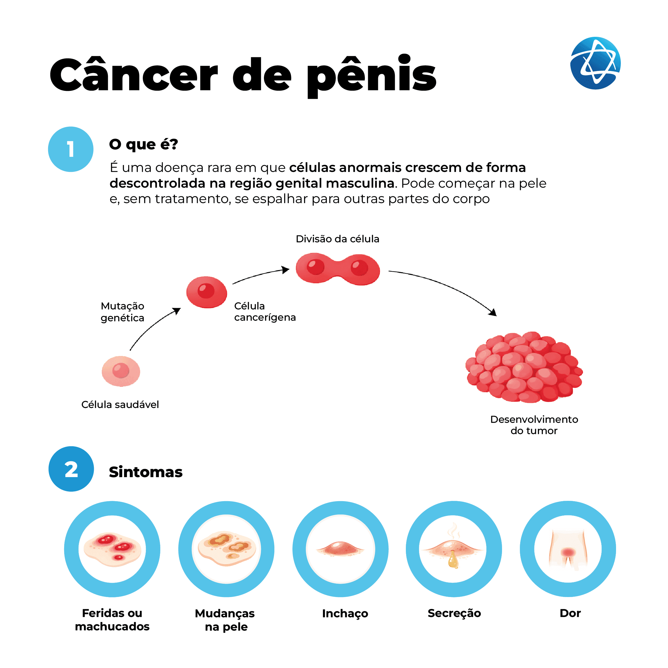 Infográfico sobre câncer de pênis: doença causada pelo crescimento descontrolado de células anormais na região genital masculina. A imagem mostra a evolução das células até o desenvolvimento do tumor e destaca sintomas como feridas, alterações na pele, inchaço, secreção e dor. Infográfico sobre câncer de pênis: doença causada pelo crescimento descontrolado de células anormais na região genital masculina. A imagem mostra a evolução das células até o desenvolvimento do tumor e destaca sintomas como feridas, alterações na pele, inchaço, secreção e dor.