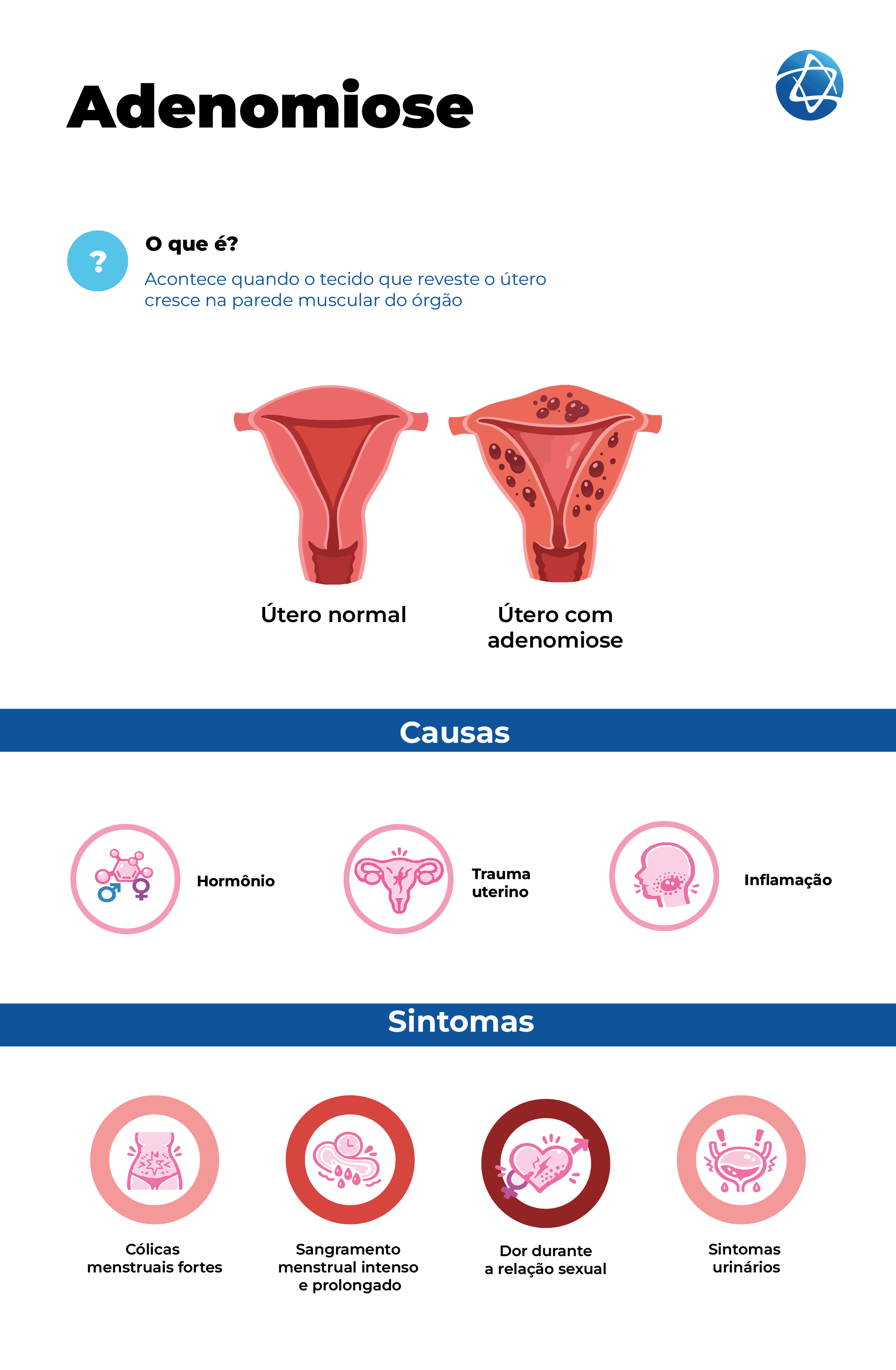 Infográfico explicando que a adenomiose acontece quando o tecido que reveste o útero cresce na parede muscular do órgão. O infográfico compara um útero normal com um útero com adenomiose. Também apresenta possíveis causas, como hormônio, trauma uterino e inflamação. Entre os sintomas listados estão cólicas menstruais fortes, sangramento menstrual intenso e prolongado, dor durante a relação sexual e sintomas urinários. Infográfico explicando que a adenomiose acontece quando o tecido que reveste o útero cresce na parede muscular do órgão. O infográfico compara um útero normal com um útero com adenomiose. Também apresenta possíveis causas, como hormônio, trauma uterino e inflamação. Entre os sintomas listados estão cólicas menstruais fortes, sangramento menstrual intenso e prolongado, dor durante a relação sexual e sintomas urinários.