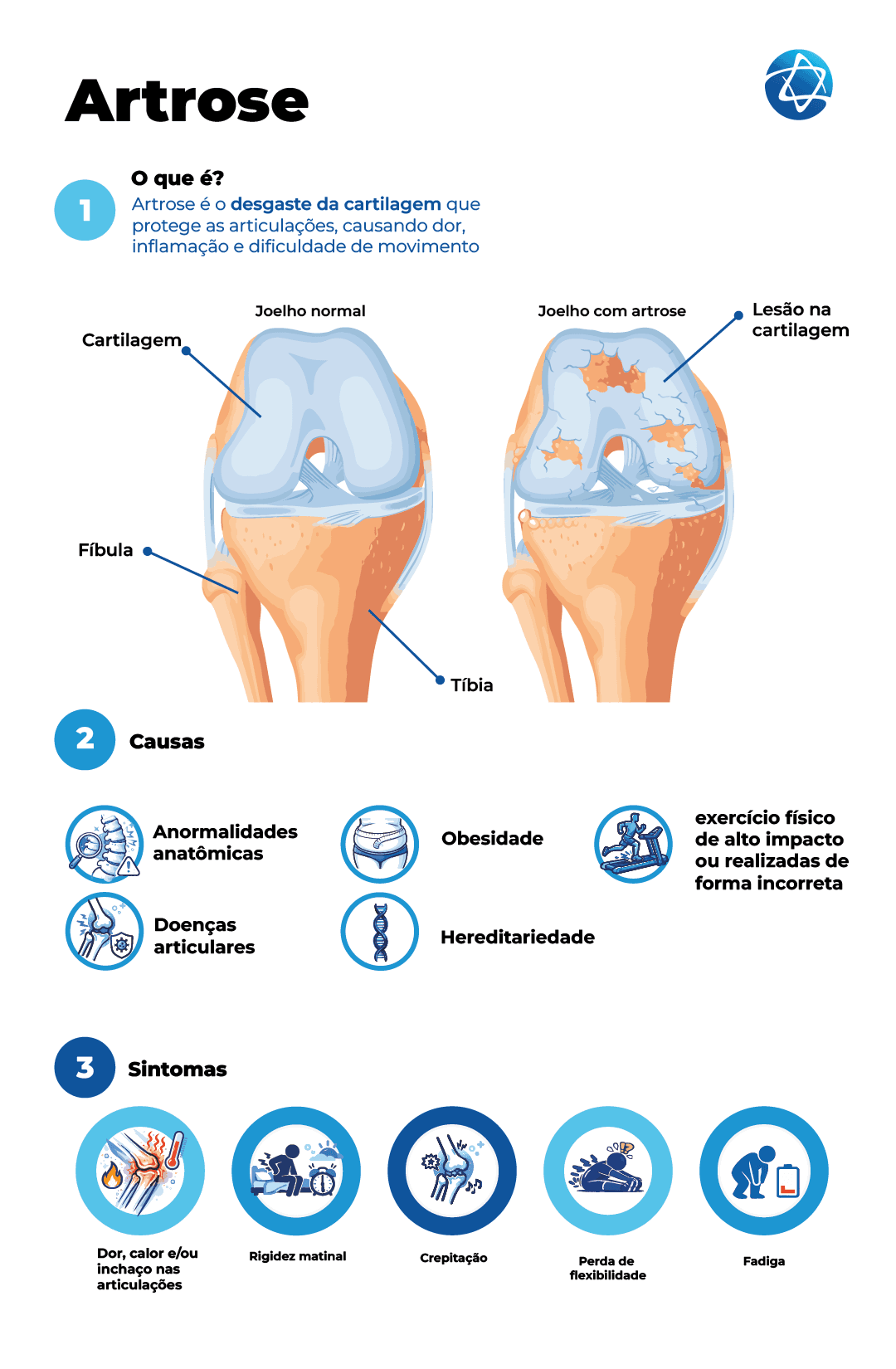 infográfico define a artrose como um desgaste da cartilagem que protege as articulações, causando dor, inflamação e dificuldade de movimento. A imagem compara um joelho normal com um joelho com artrose e identifica estruturas como cartilagem, fíbula, tíbia e lesão na cartilagem. Também apresenta possíveis causas, como anormalidades anatômicas, obesidade, exercício físico de alto impacto ou realizado de forma incorreta, doenças articulares e hereditariedade infográfico define a artrose como um desgaste da cartilagem que protege as articulações, causando dor, inflamação e dificuldade de movimento. A imagem compara um joelho normal com um joelho com artrose e identifica estruturas como cartilagem, fíbula, tíbia e lesão na cartilagem. Também apresenta possíveis causas, como anormalidades anatômicas, obesidade, exercício físico de alto impacto ou realizado de forma incorreta, doenças articulares e hereditariedade
