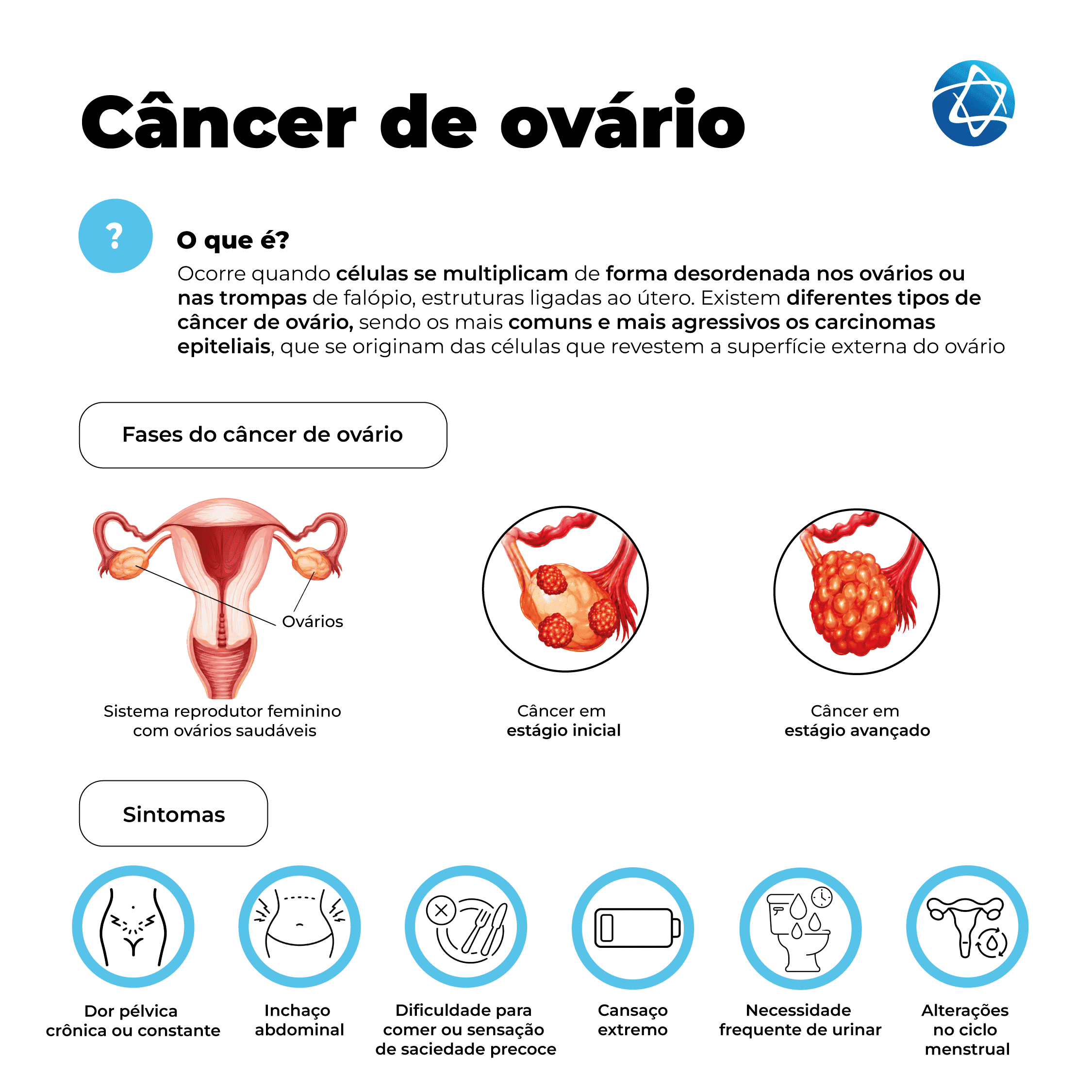 Infográfico sobre câncer de ovário. Explica que a doença ocorre quando células se multiplicam de forma desordenada nos ovários ou nas trompas de falópio. Mostra o sistema reprodutor feminino com ovários saudáveis, câncer em estágio inicial e câncer em estágio avançado, além dos sintomas: dor pélvica crônica ou constante, inchaço abdominal, dificuldade para comer ou sensação de saciedade precoce, cansaço extremo, necessidade frequente de urinar e alterações no ciclo menstrual. Infográfico sobre câncer de ovário. Explica que a doença ocorre quando células se multiplicam de forma desordenada nos ovários ou nas trompas de falópio. Mostra o sistema reprodutor feminino com ovários saudáveis, câncer em estágio inicial e câncer em estágio avançado, além dos sintomas: dor pélvica crônica ou constante, inchaço abdominal, dificuldade para comer ou sensação de saciedade precoce, cansaço extremo, necessidade frequente de urinar e alterações no ciclo menstrual.