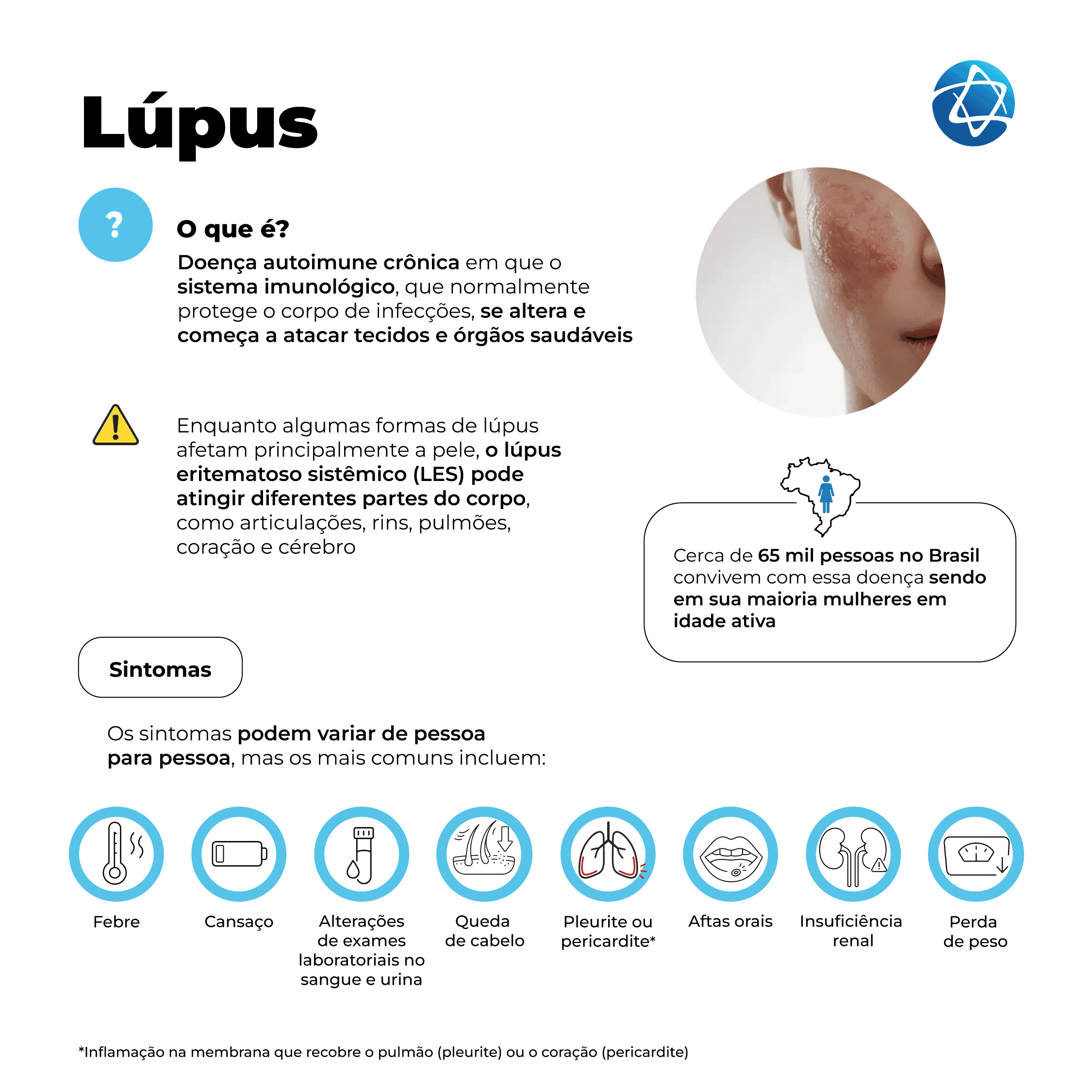 Infográfico sobre lúpus com imagem de lesão no rosto, explicando o que é a doença autoimune, chama atenção para o fato de o lúpus eritematoso sistêmico (LES) poder atingir diferentes partes do corpo, informa que cerca de 65 mil pessoas no Brasil convivem com a doença e ilustra sintomas como febre, cansaço, queda de cabelo e insuficiência renal. Infográfico sobre lúpus com imagem de lesão no rosto, explicando o que é a doença autoimune, chama atenção para o fato de o lúpus eritematoso sistêmico (LES) poder atingir diferentes partes do corpo, informa que cerca de 65 mil pessoas no Brasil convivem com a doença e ilustra sintomas como febre, cansaço, queda de cabelo e insuficiência renal.