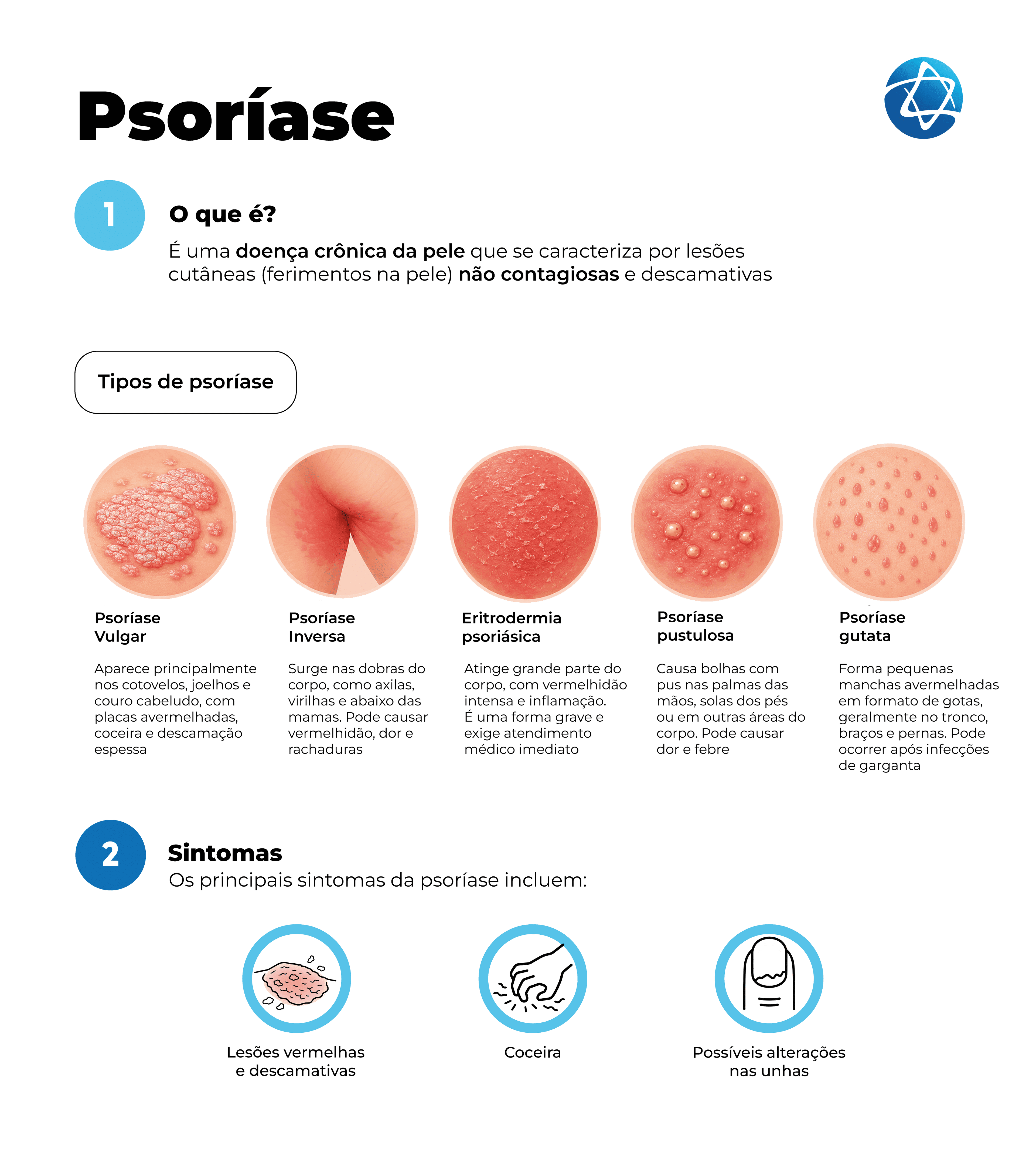 Infográfico sobre psoríase explicando o que é a doença, uma condição crônica da pele, não contagiosa, com lesões cutâneas descamativas. Mostra os principais tipos de psoríase, incluindo vulgar, inversa, eritrodérmica, pustulosa e gutata, com ilustrações de placas, vermelhidão, bolhas e manchas. Também destaca sintomas comuns, como lesões vermelhas e descamativas, coceira e possíveis alterações nas unhas. Infográfico sobre psoríase explicando o que é a doença, uma condição crônica da pele, não contagiosa, com lesões cutâneas descamativas. Mostra os principais tipos de psoríase, incluindo vulgar, inversa, eritrodérmica, pustulosa e gutata, com ilustrações de placas, vermelhidão, bolhas e manchas. Também destaca sintomas comuns, como lesões vermelhas e descamativas, coceira e possíveis alterações nas unhas.