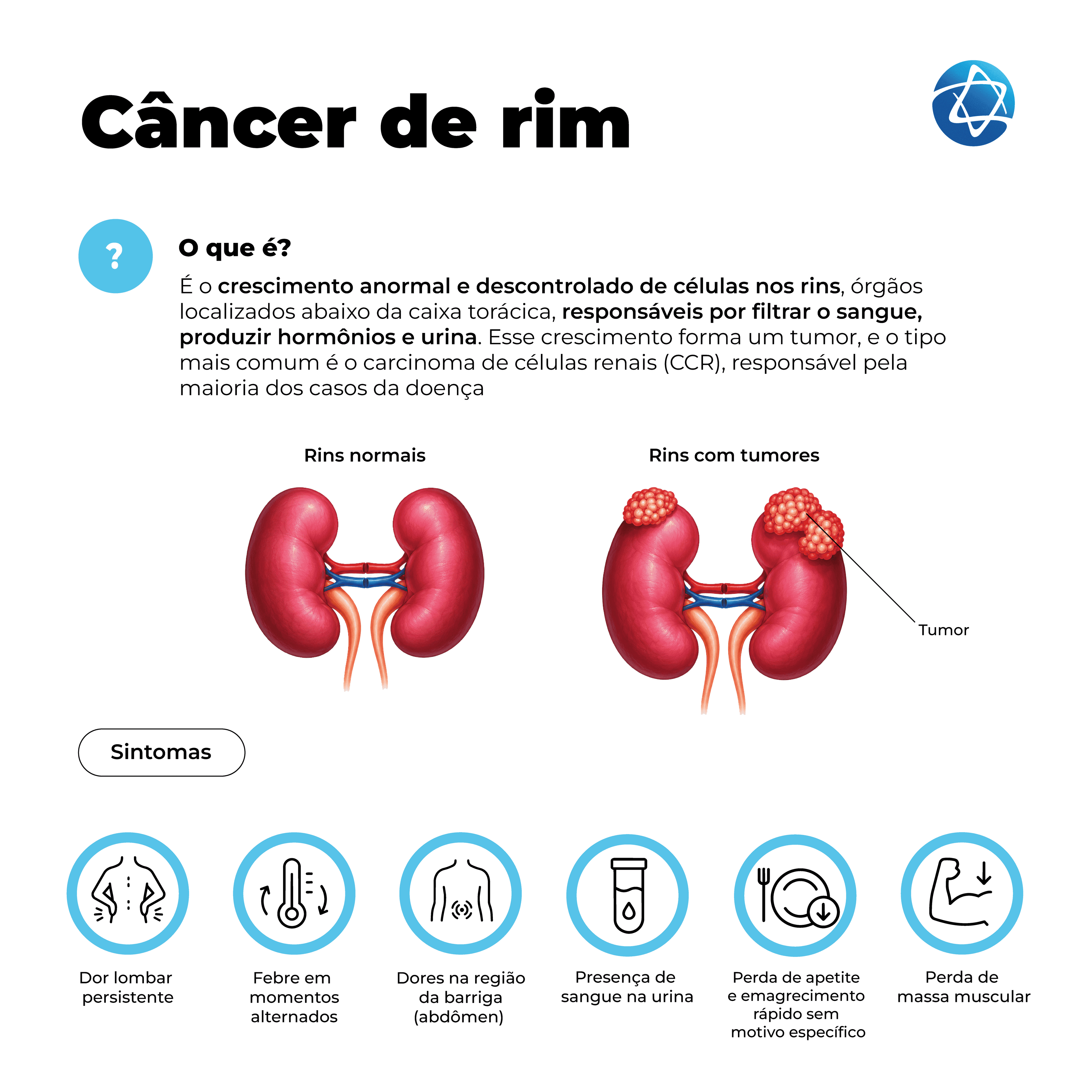 Infográfico sobre câncer de rim explicando que a doença ocorre pelo crescimento anormal e descontrolado de células nos rins. Compara rins normais e rins com tumores, além de destacar sintomas como dor lombar persistente, febre em momentos alternados, dor abdominal, presença de sangue na urina, perda de apetite, emagrecimento rápido e perda de massa muscular. Infográfico sobre câncer de rim explicando que a doença ocorre pelo crescimento anormal e descontrolado de células nos rins. Compara rins normais e rins com tumores, além de destacar sintomas como dor lombar persistente, febre em momentos alternados, dor abdominal, presença de sangue na urina, perda de apetite, emagrecimento rápido e perda de massa muscular.