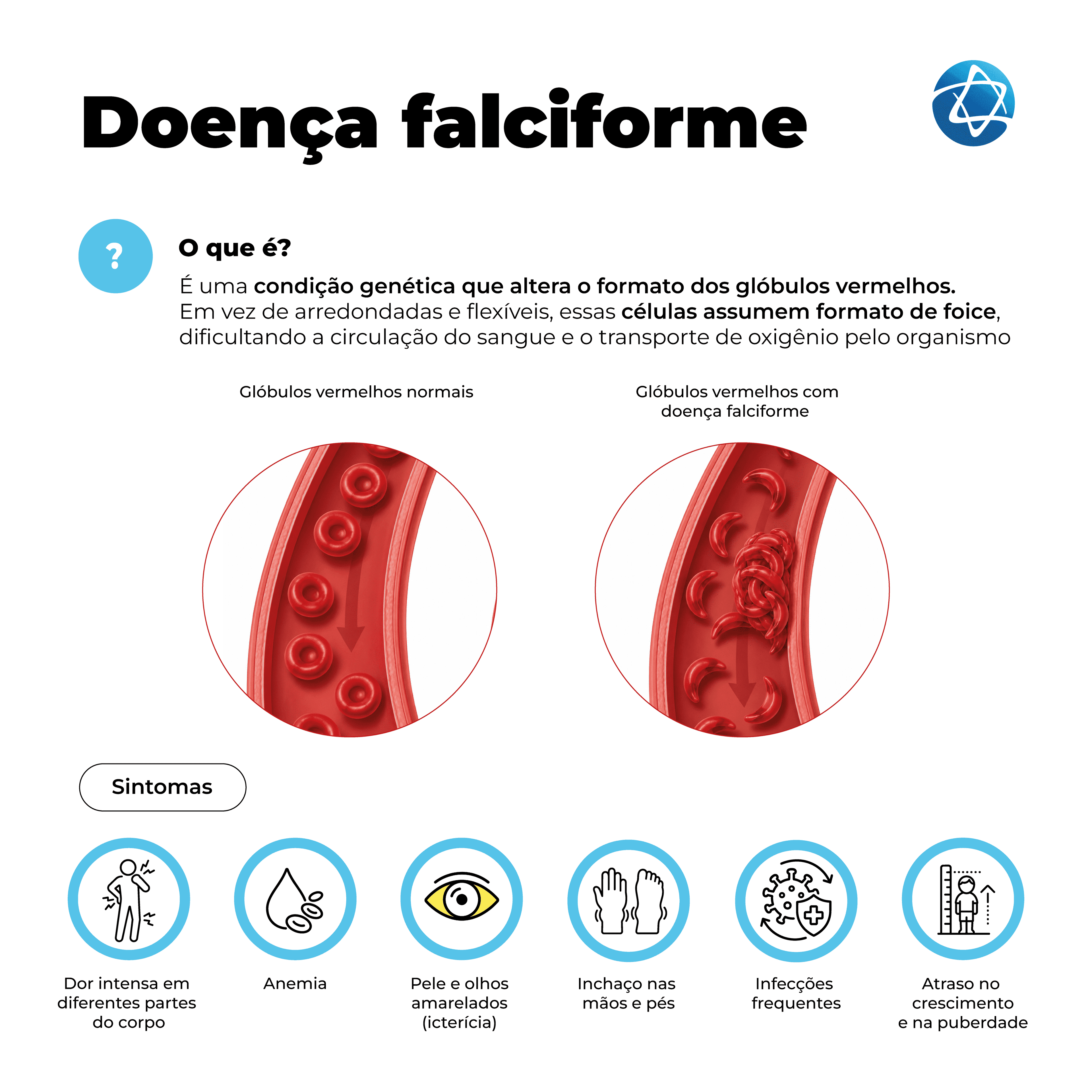 Infográfico sobre doença falciforme explicando que é uma condição genética que altera o formato dos glóbulos vermelhos, dificultando a circulação do sangue e o transporte de oxigênio. Compara glóbulos vermelhos normais e em formato de foice, além de sintomas como dor intensa, anemia, icterícia, inchaço nas mãos e pés, infecções frequentes e atraso no crescimento. Infográfico sobre doença falciforme explicando que é uma condição genética que altera o formato dos glóbulos vermelhos, dificultando a circulação do sangue e o transporte de oxigênio. Compara glóbulos vermelhos normais e em formato de foice, além de sintomas como dor intensa, anemia, icterícia, inchaço nas mãos e pés, infecções frequentes e atraso no crescimento.