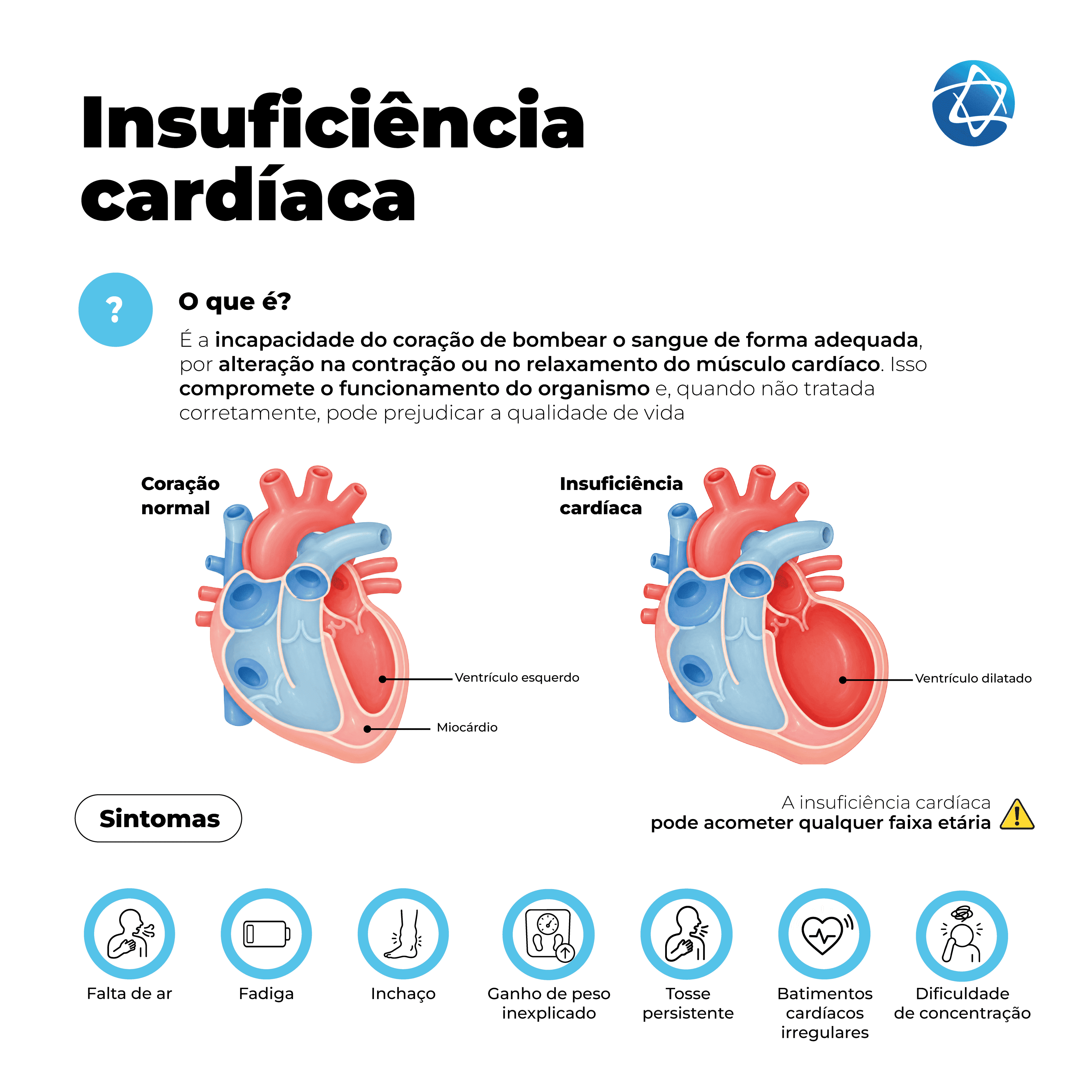 Infográfico sobre insuficiência cardíaca explicando que a condição ocorre quando o coração não consegue bombear sangue adequadamente. Compara coração normal e coração com insuficiência cardíaca, destacando sintomas como falta de ar, fadiga, inchaço, ganho de peso inexplicado, tosse persistente, batimentos irregulares e dificuldade de concentração. Infográfico sobre insuficiência cardíaca explicando que a condição ocorre quando o coração não consegue bombear sangue adequadamente. Compara coração normal e coração com insuficiência cardíaca, destacando sintomas como falta de ar, fadiga, inchaço, ganho de peso inexplicado, tosse persistente, batimentos irregulares e dificuldade de concentração.