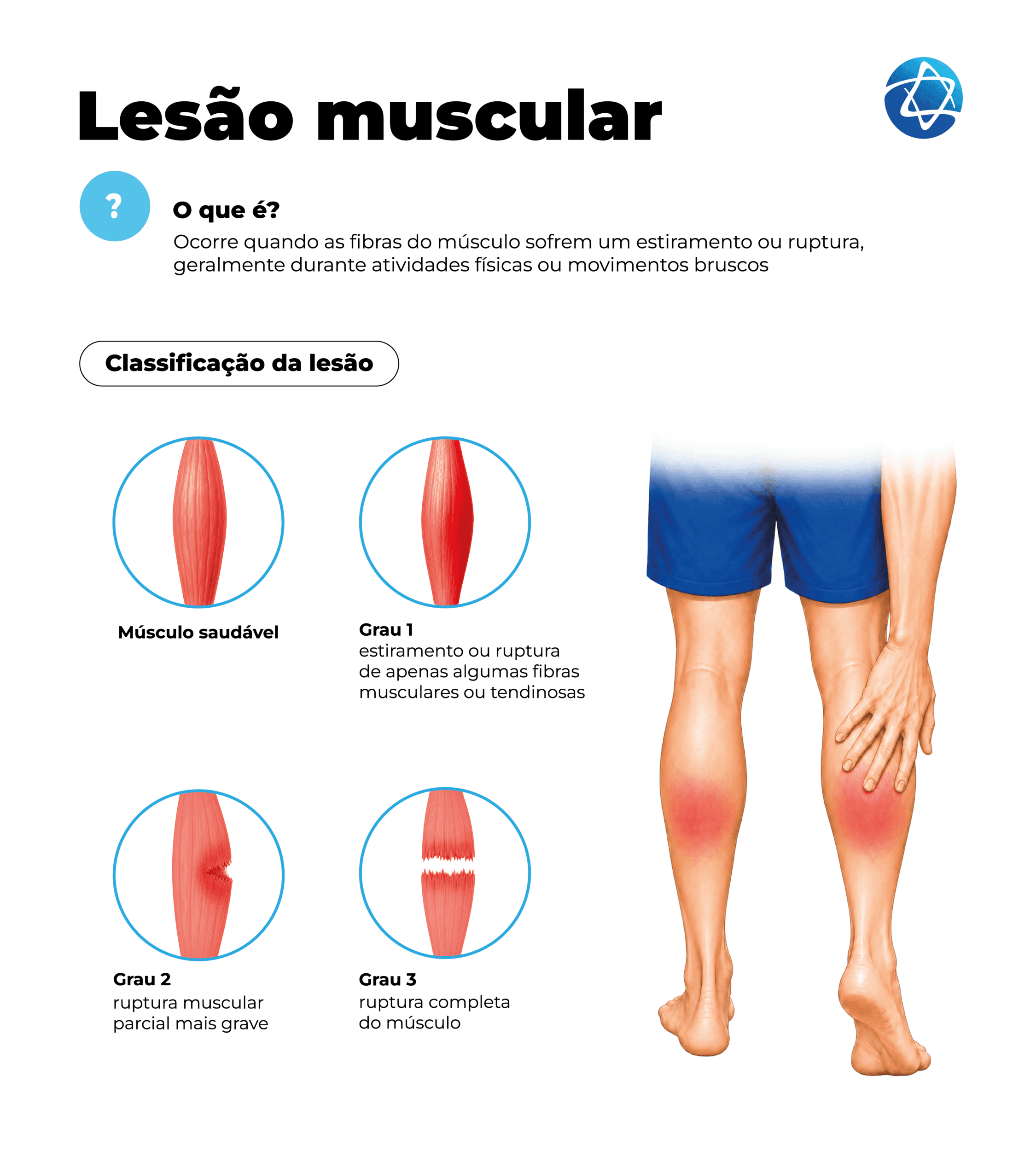 Infográfico sobre lesão muscular explicando que a condição ocorre quando as fibras do músculo sofrem estiramento ou ruptura. Mostra a classificação da lesão em músculo saudável, grau 1, grau 2 e grau 3, além de ilustração de dor na região posterior da perna. Infográfico sobre lesão muscular explicando que a condição ocorre quando as fibras do músculo sofrem estiramento ou ruptura. Mostra a classificação da lesão em músculo saudável, grau 1, grau 2 e grau 3, além de ilustração de dor na região posterior da perna.