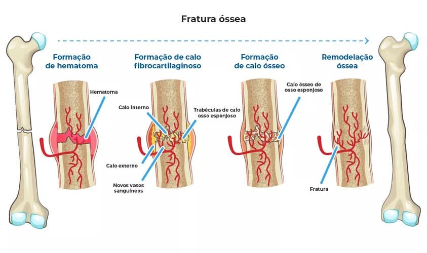 Esquema gráfico que mostra como ocorre a reparação de fratura Esquema gráfico que mostra como ocorre a reparação de fratura