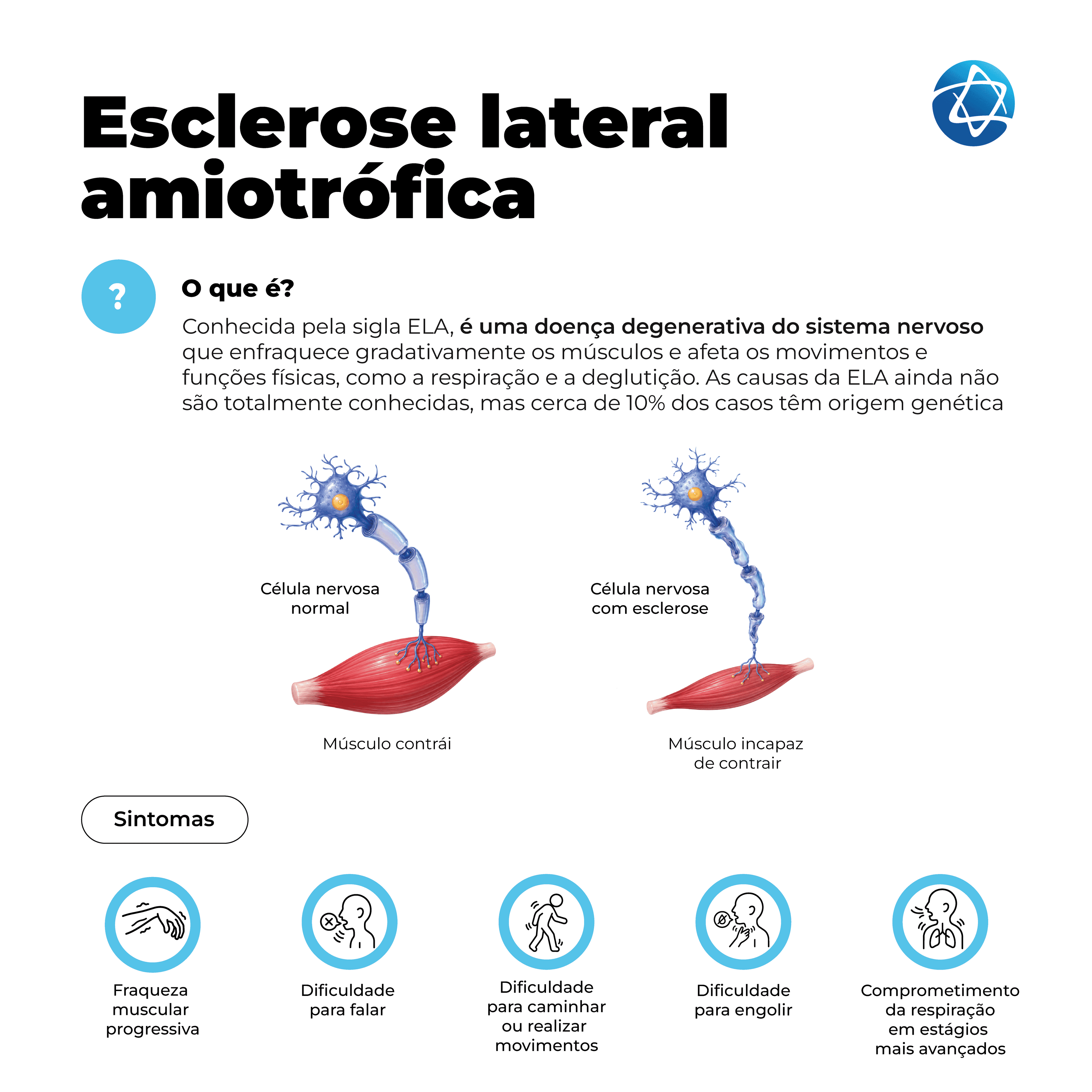 Infográfico sobre esclerose lateral amiotrófica, ou ELA, explicando que é uma doença degenerativa do sistema nervoso que enfraquece os músculos e afeta movimentos, respiração e deglutição. Compara célula nervosa normal e célula nervosa com esclerose, além de sintomas como fraqueza muscular progressiva, dificuldade para falar, caminhar, engolir e respirar. Infográfico sobre esclerose lateral amiotrófica, ou ELA, explicando que é uma doença degenerativa do sistema nervoso que enfraquece os músculos e afeta movimentos, respiração e deglutição. Compara célula nervosa normal e célula nervosa com esclerose, além de sintomas como fraqueza muscular progressiva, dificuldade para falar, caminhar, engolir e respirar.