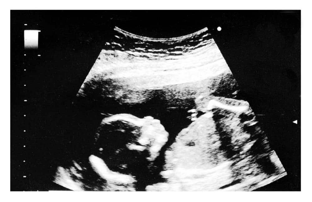 Ultrassom na 17ª semana já exibe a silhueta do do bebê