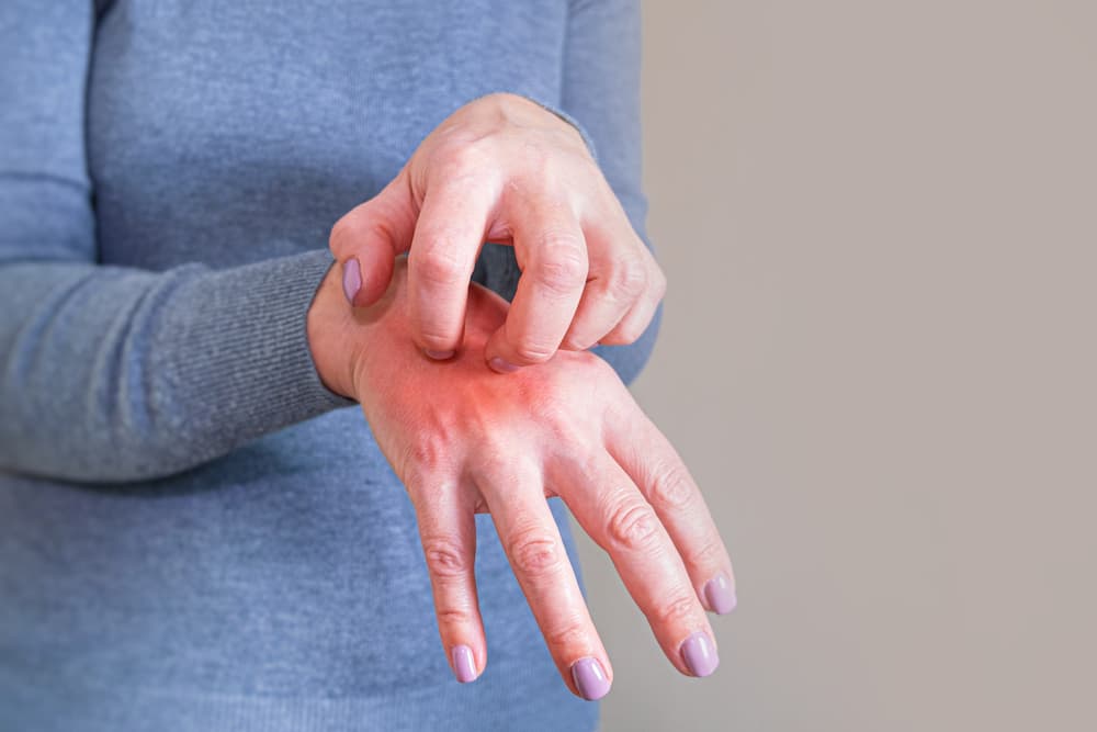A,Young,Woman,Scratches,Her,Hand.,Skin,Inflammation.,Problems,Of