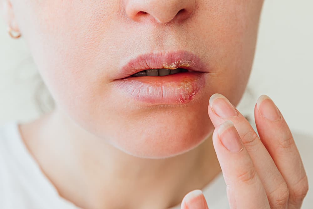 Pessoa com sinais de de herpes nos lábios.