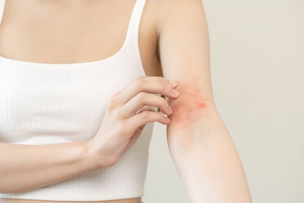 eczema-causa-coceiras-e-requer-reidratacao-para-o-tratamento