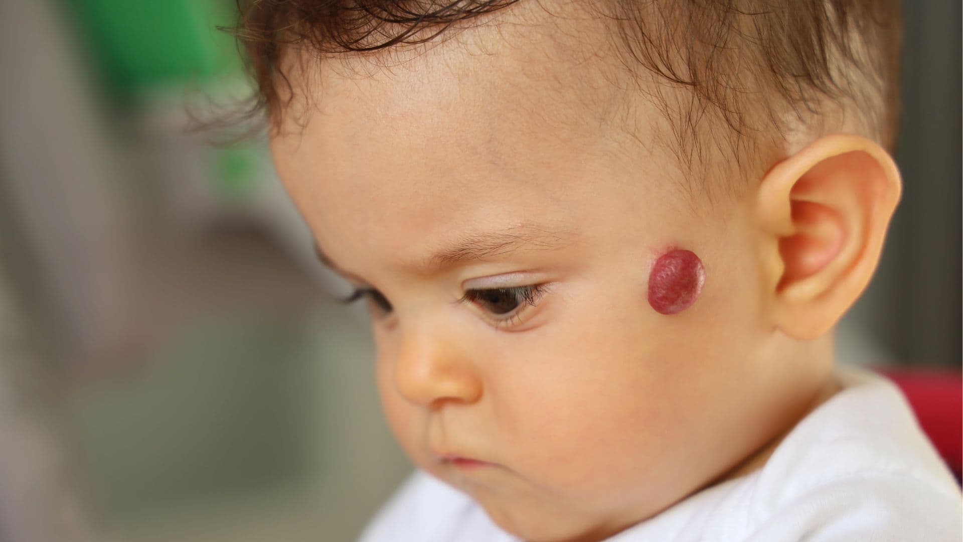 hemangioma
