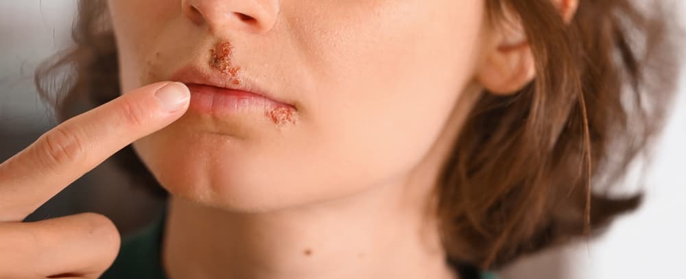 Herpes labial, genital ou zóster?