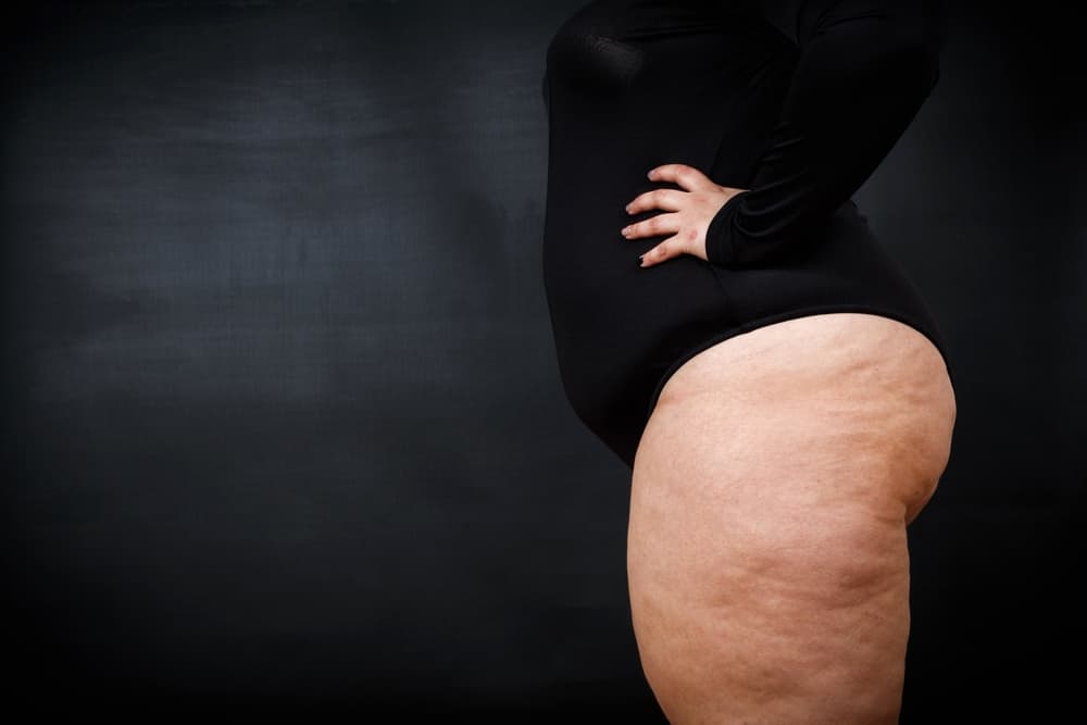 Lipedema: conheça a doença que provoca deformação corporal e é confundida com obesidade