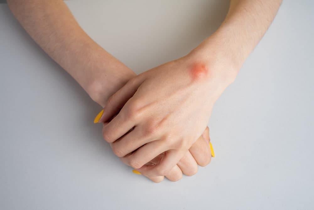 lipoma-e-um-tumor-benigno-que-fica-sob-a-pele