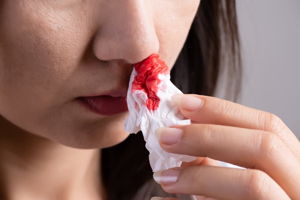 Nosebleed,,,A,Young,Woman,Suffering,From,Nose,Bleeding,And