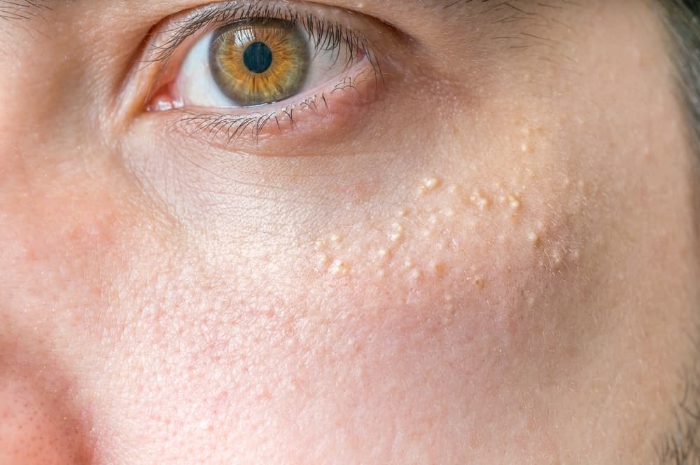 Milia,(milium),-,Pimples,Around,Eye,On,Skin.