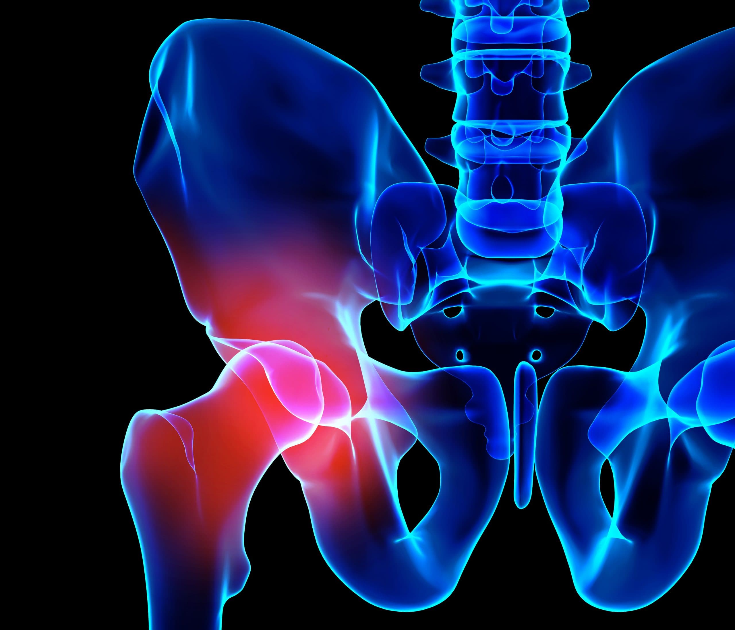 Osteonecrose da cabeça femoral: confira os sintomas e os tratamentos disponíveis