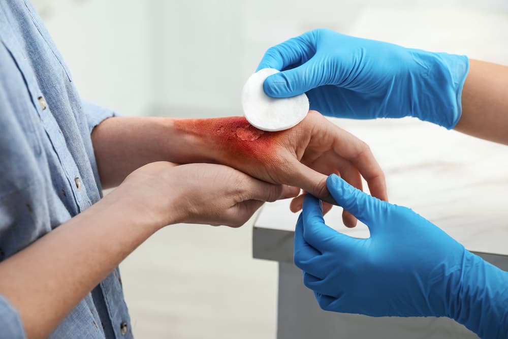 Doctor,Covering,Patient's,Burn,Of,Hand,With,Cotton,Pad,Indoors,